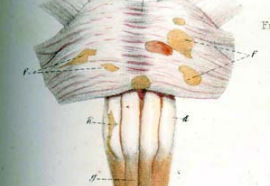 Drawing showing lesions in brain stem and spinal cord.